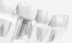 Dental Implants in Lubbock