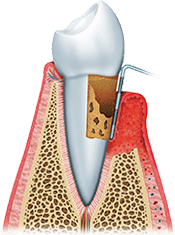 Dental implant cross-section showing titanium post integrated into jawbone structure with gum tissue.
