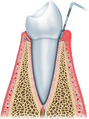 Dental implant cross-section showing tooth structure, bone density, and implant placement in gum tissue.