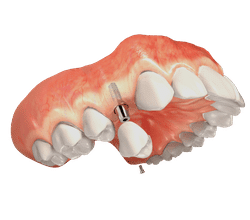 Dental implant illustration showing prosthetic tooth placement in jaw bone structure.