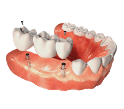 Dental implant model showing tooth replacement procedure with implants and crowns on gum model.