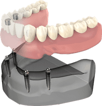 Dental implant model showing tooth replacement procedure with implants anchored in jawbone structure.