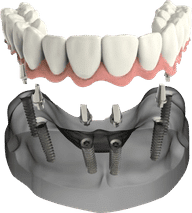 Dental implant illustration showing prosthetic teeth on implant posts in jawbone model.