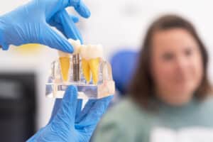 dental implant