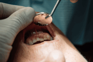 Gum Disease Treatment