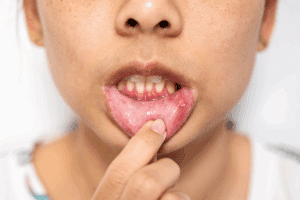 Gum Disease Treatment