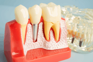 Lubbock Dental Implants