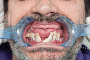 Periodontal Disease
