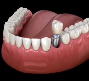 Dental implant illustration showing titanium post anchored in jawbone with crown restoration.