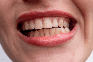 Laser periodontal therapy