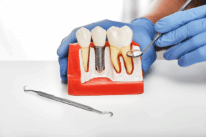 Natural-Looking Dental Implants