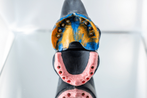 implant-supported overdentures