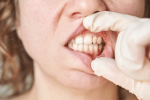 Gum disease treatment